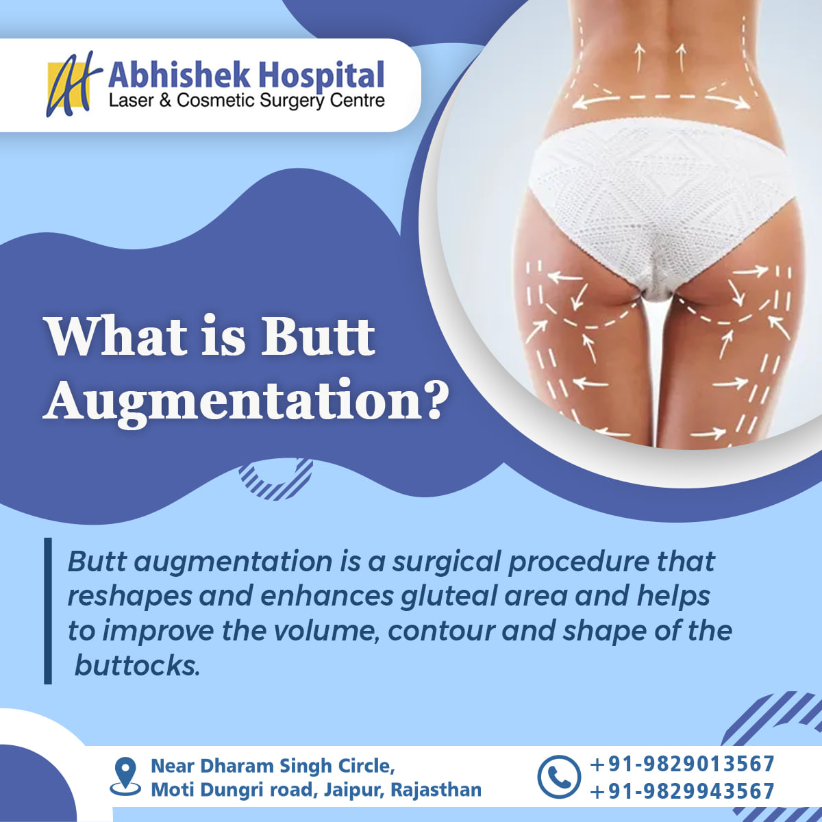 Buttock Augmentation