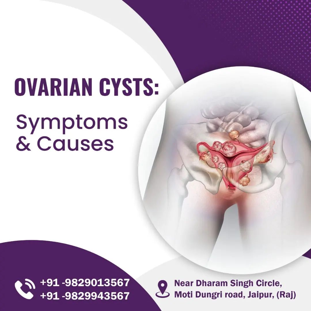 Ovarian Cyst