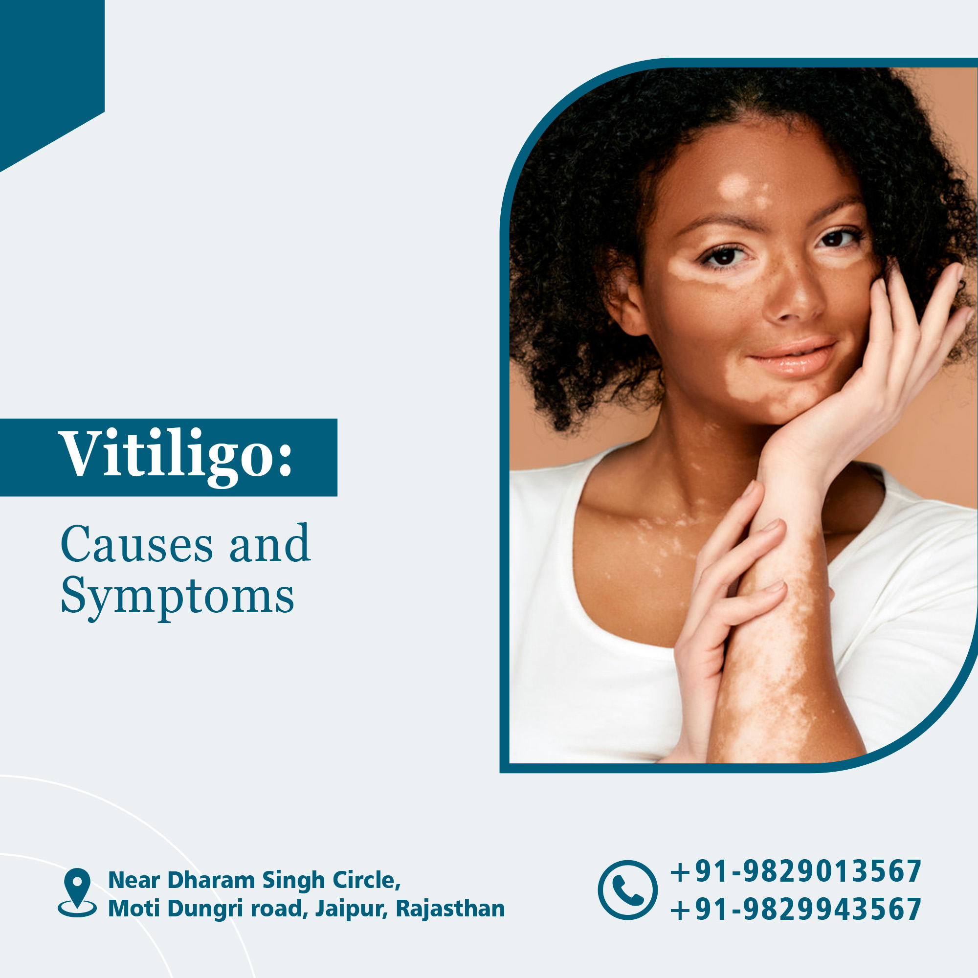 Vitiligo: Causes and Symptoms
