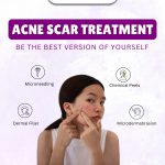 Best Acne Scar Treatment