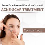 Tired of acne scars affecting your confidence?