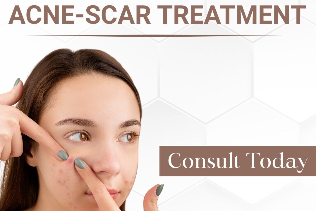 Tired of acne scars affecting your confidence?