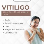 Vitiligo can affect these areas of body
