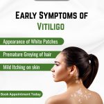 Early Symptoms of Vitiligo