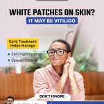 Vitiligo