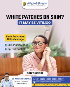 Early Treatment of Vitiligo Helps Manage