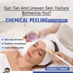 Chemical Peeling