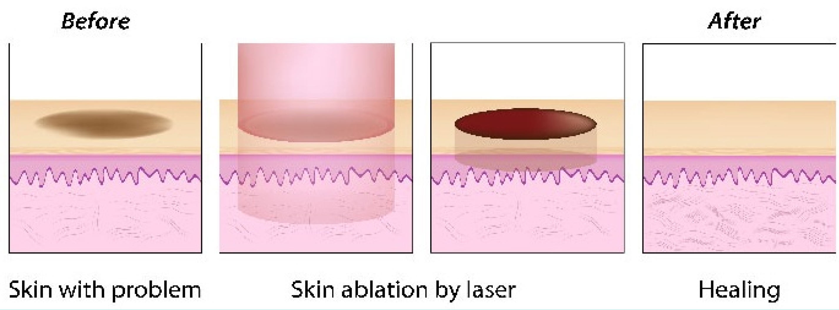 Acne Scars Treatment Doctor