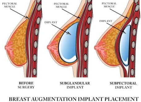 Breast Augmentation Sizing System