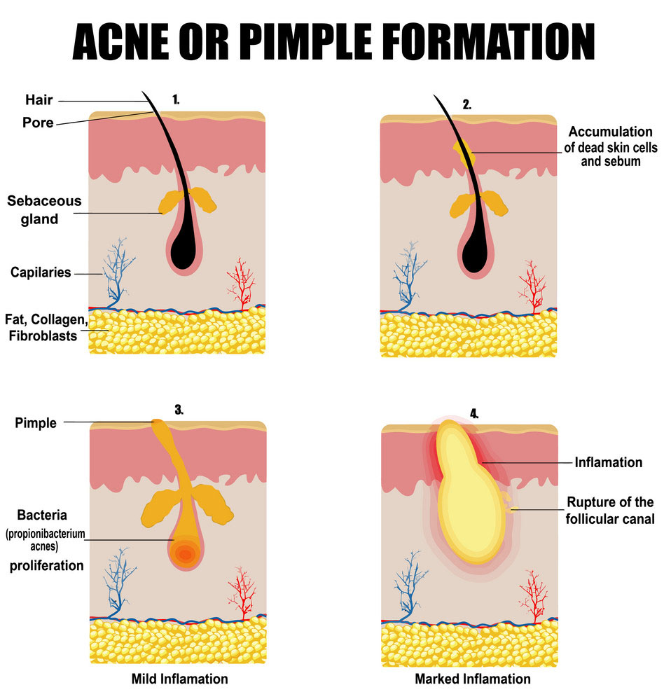 acne scars