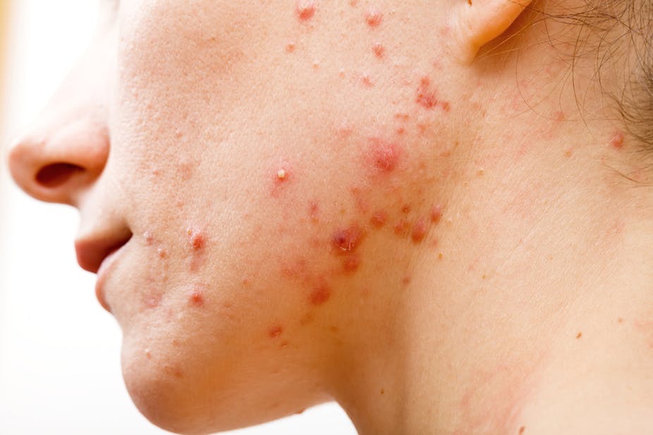 Best treatment of acne in jaipur