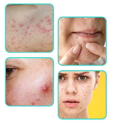 Symptoms of acne