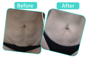 Best Hospital for Tummy Tuck Surgery in Jaipur