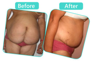 Tummy Tuck Surgery in Jaipur