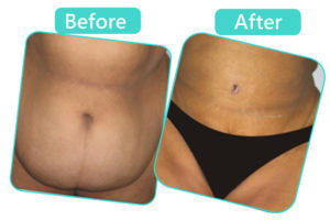 Tummy Tuck Surgery Cost in Jaipur Rajasthan