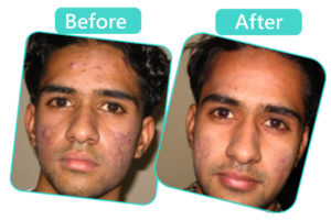Acne Scars Treatment Doctor