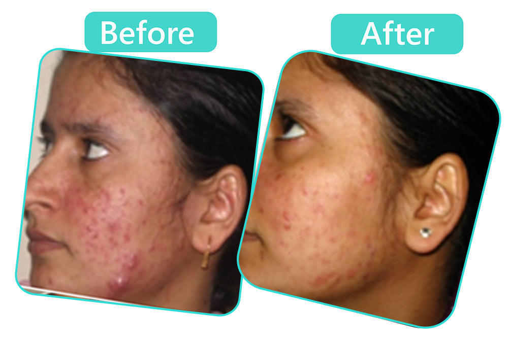 Acne Scars Treatment Doctor in Jaipur, Acne Scars Treatment in Jaipur