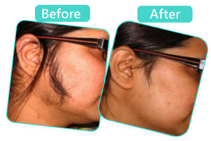 laser hair removal Jaipur