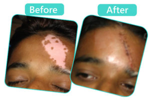 Vitiligo treatment In Jaipur