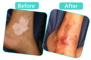 Best Vitiligo treatment in jaipur