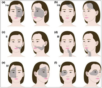 Vitiligo-Treatment