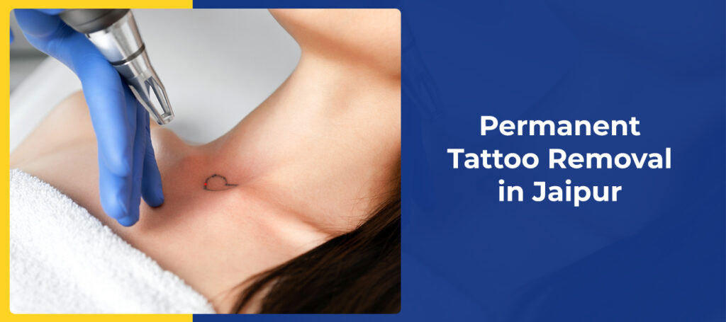 Permanent Tattoo Removal in Jaipur